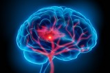 Avellino – Convegno organizzato dall’Unità Operativa di Neurologia sull’ictus cerebrale
