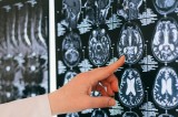 Associazione Carla Russo: “Nasce documento per dare impulso a neuro-oncologia campana”