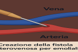 Dialisi: nuova tecnica mini-invasiva ad Avellino Dialisi: nuova tecnica mini-invasiva ad Avellino