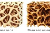 Giornata Mondiale dell’Osteoporosi Giornata Mondiale dell’Osteoporosi