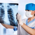 medical doctor looking at x-ray picture of lungs in hospital