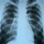 pneumonia test scanning, modern x-rays radiography