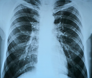 pneumonia test scanning, modern x-rays radiography