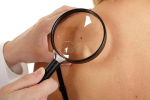 Prevenzione-melanoma