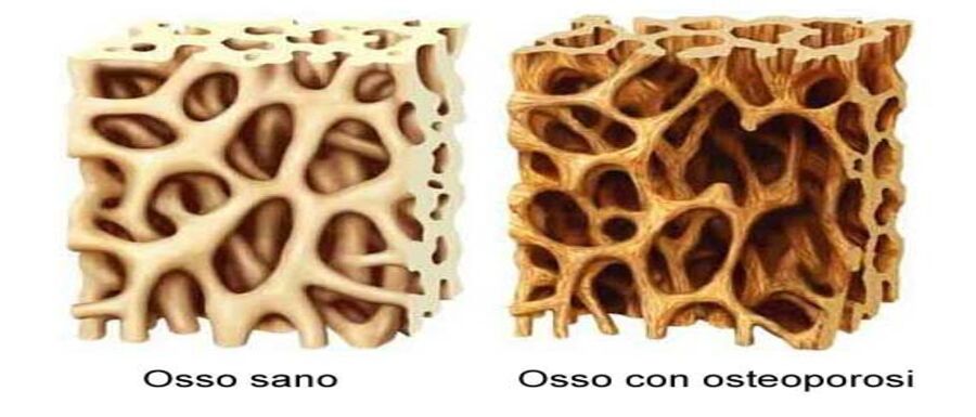 osteoporosi-3-2